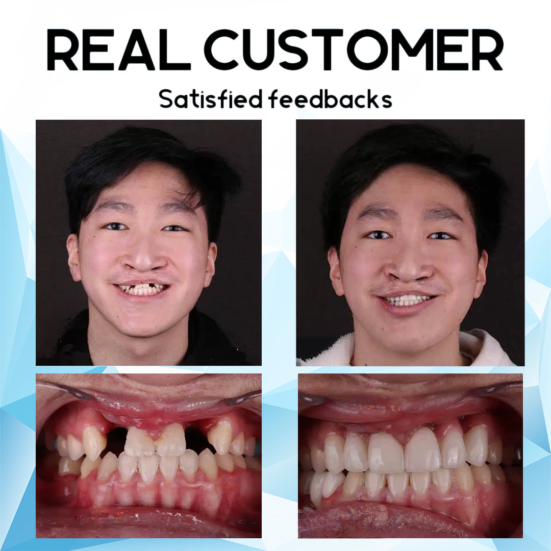 NEGUSY™ 💙Silicone Reline Denture Set(🔥Limited time discount 70%🔥)