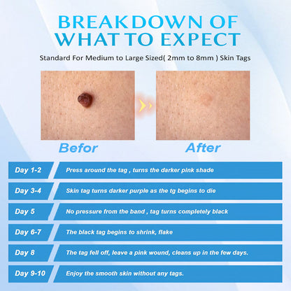 Seurico™ At-home Skin Tag Removal Pen